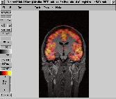 \includegraphics[width=0.3\textwidth]{images/inspect_overlay_coronal.ps}